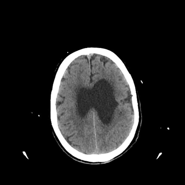 File:Cerebellar metastasis - lung tumor (Radiopaedia 69317-79145 Axial non-contrast 27).jpg