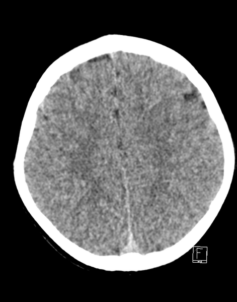 File:Cerebellar stroke (Radiopaedia 32202-33149 Axial non-contrast 21).png