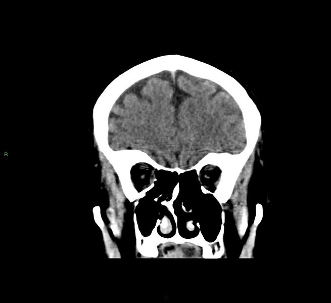File:Cerebral amyloid angiopathy-associated lobar intracerebral hemorrhage (Radiopaedia 58376-65511 Coronal non-contrast 50).jpg