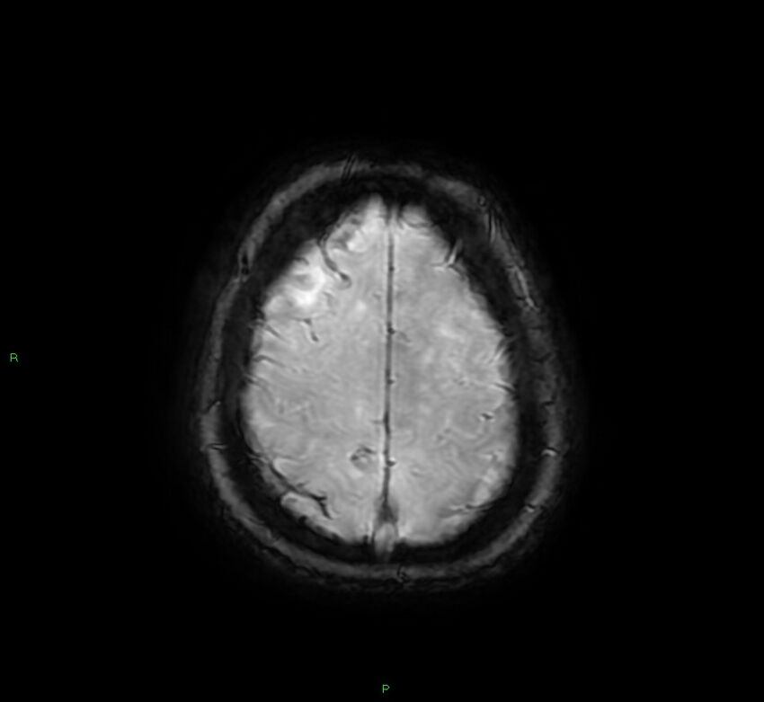 Cerebral amyloid angiopathy-associated lobar intracerebral hemorrhage (Radiopaedia 58378-65517 Axial SWI 62).jpg
