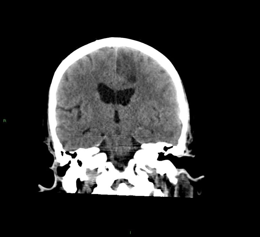 Cerebral amyloid angiopathy-associated lobar intracerebral hemorrhage (Radiopaedia 58529-65681 Coronal non-contrast 33).jpg