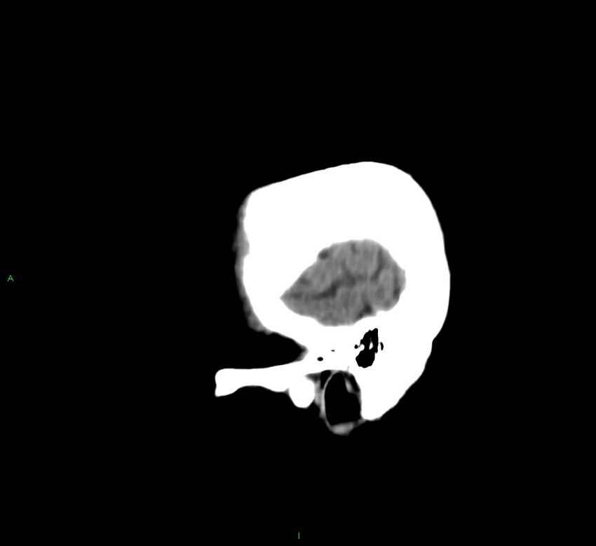 Cerebral amyloid angiopathy-associated lobar intracerebral hemorrhage (Radiopaedia 58530-65688 C 6).jpg