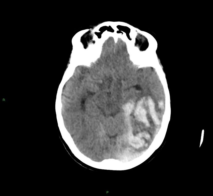 Cerebral amyloid angiopathy-associated lobar intracerebral hemorrhage (Radiopaedia 58754-65975 Axial non-contrast 39).jpg