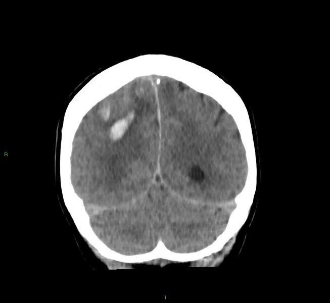 File:Cerebral amyloid angiopathy-associated lobar intracerebral hemorrhage (Radiopaedia 58756-65977 Coronal non-contrast 20).jpg