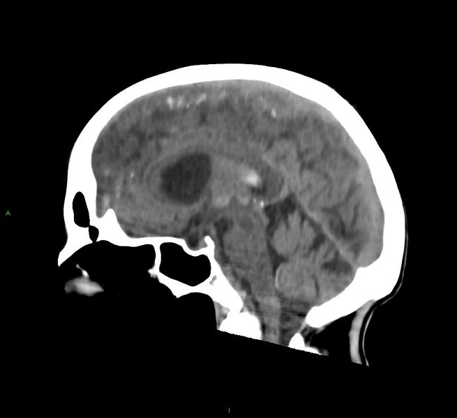File:Cerebral amyloid angiopathy-associated lobar intracerebral hemorrhage (Radiopaedia 58758-65980 C 28).jpg
