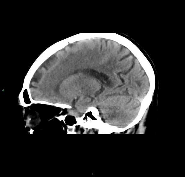 File:Cerebral amyloid angiopathy-associated lobar intracerebral hemorrhage (Radiopaedia 59356-66716 C 35).jpg