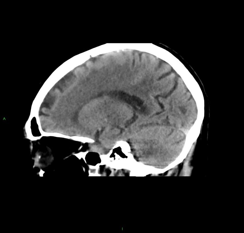 Cerebral amyloid angiopathy-associated lobar intracerebral hemorrhage (Radiopaedia 59356-66716 C 35).jpg