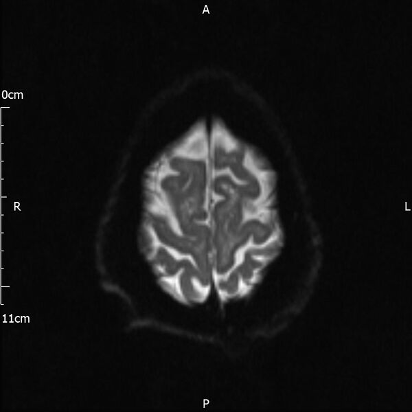 File:Cerebral amyloid angiopathy related inflammation (Radiopaedia 72772-83415 Axial DWI 21).jpg