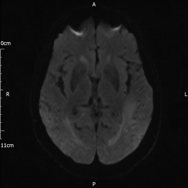 File:Cerebral amyloid angiopathy related inflammation (Radiopaedia 72772-83415 Axial DWI 35).jpg