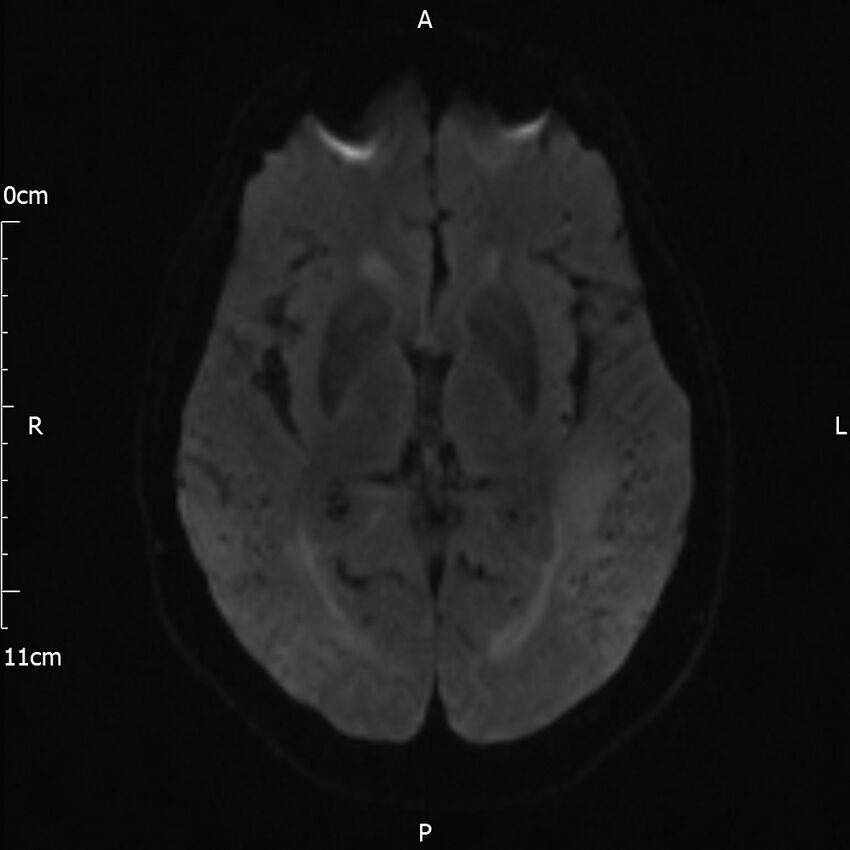 Cerebral amyloid angiopathy related inflammation (Radiopaedia 72772-83415 Axial DWI 35).jpg