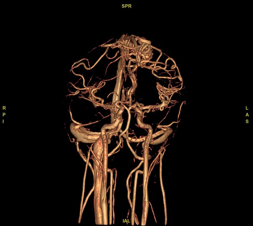 Cerebral arteriovenous malformation (Radiopaedia 61964-70029 VRT 39).jpg