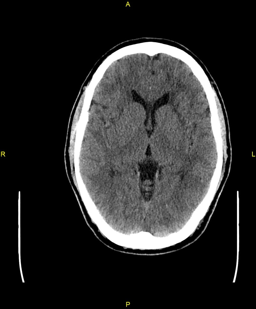 Cerebral autosomal dominant arteriopathy with subcortical infarcts and leukoencephalopathy (CADASIL) (Radiopaedia 86108-102051 Axial non-contrast 51).jpg