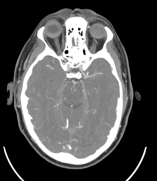 File:Cerebral dural venous sinus thrombosis (Radiopaedia 86514-102576 A 46).jpg