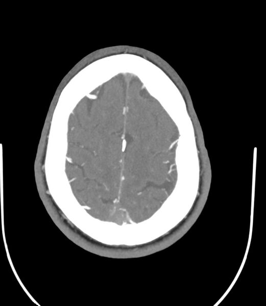File:Cerebral dural venous sinus thrombosis (Radiopaedia 86514-102576 A 80).jpg