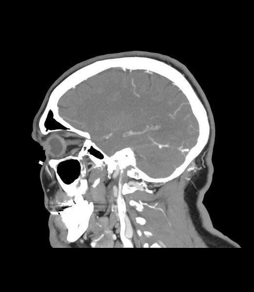 File:Cerebral dural venous sinus thrombosis (Radiopaedia 86514-102576 C 42).jpg