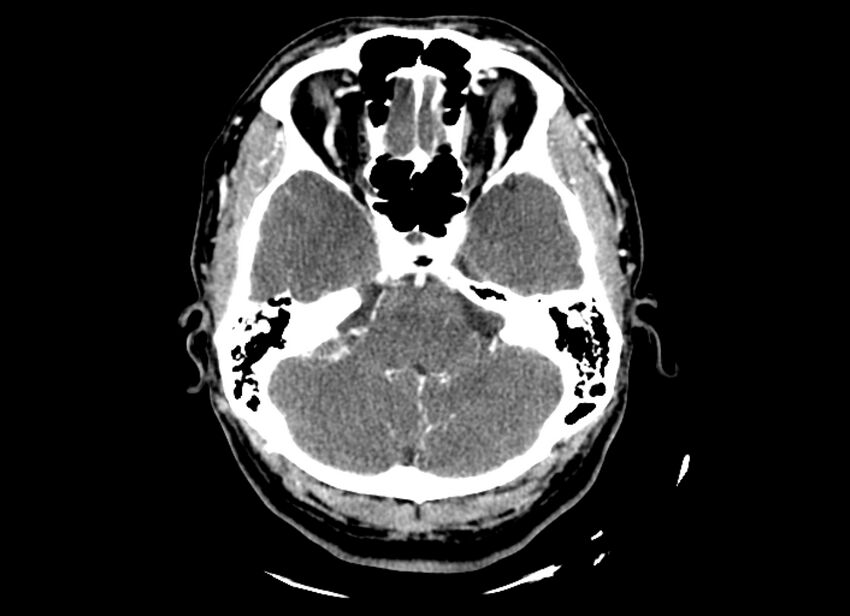 Cerebral edema (Radiopaedia 82519-96661 B 44).jpg
