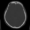 Cerebral hemorrhagic contusions (Radiopaedia 23145-23188 Axial bone window 28).jpg