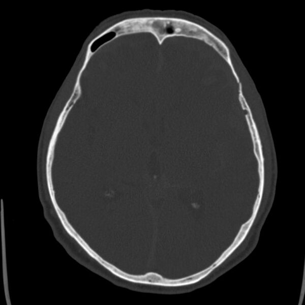 File:Cerebral hemorrhagic contusions (Radiopaedia 23145-23188 Axial bone window 28).jpg