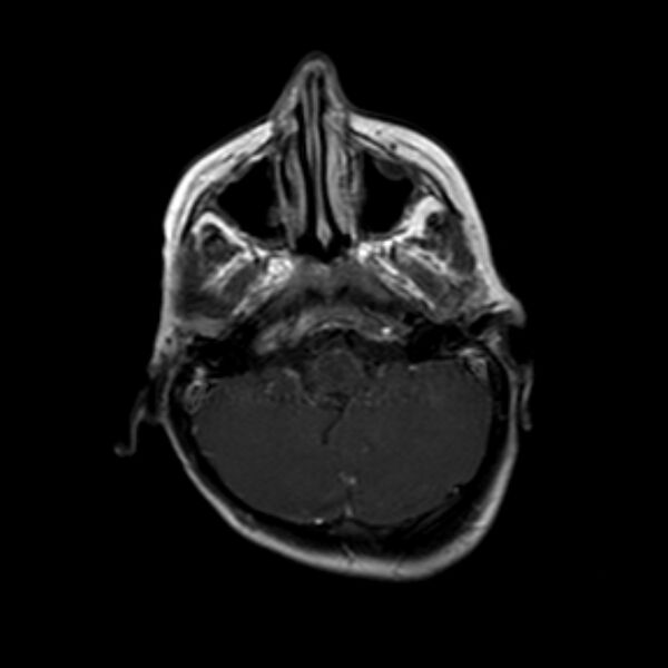 File:Cerebral tuberculoma (Radiopaedia 41152-43932 Axial T1 C+ 4).jpg