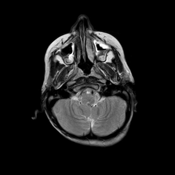 File:Cerebral tuberculoma (Radiopaedia 41152-43932 Axial T2 3).jpg
