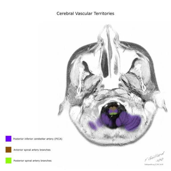File:Cerebral vascular territories (illustration) (Radiopaedia 10814).png