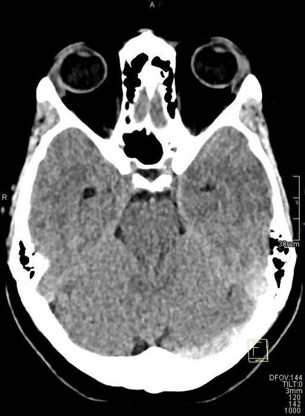 File:Cerebral venous sinus thrombosis (Radiopaedia 91329-108965 Axial non-contrast 17).jpg
