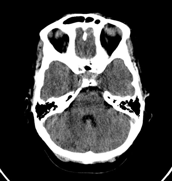 File:Cerebral venous thrombosis - CT only (Radiopaedia 41031-43778 Axial non-contrast 63).jpg