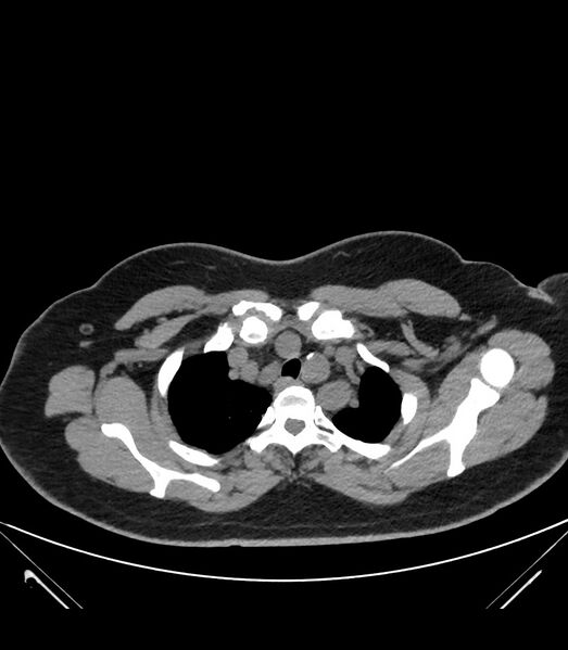 File:Cervical aortic arch with coarctation and aneurysms (Radiopaedia 44035-47552 Axial non-contrast 13).jpg