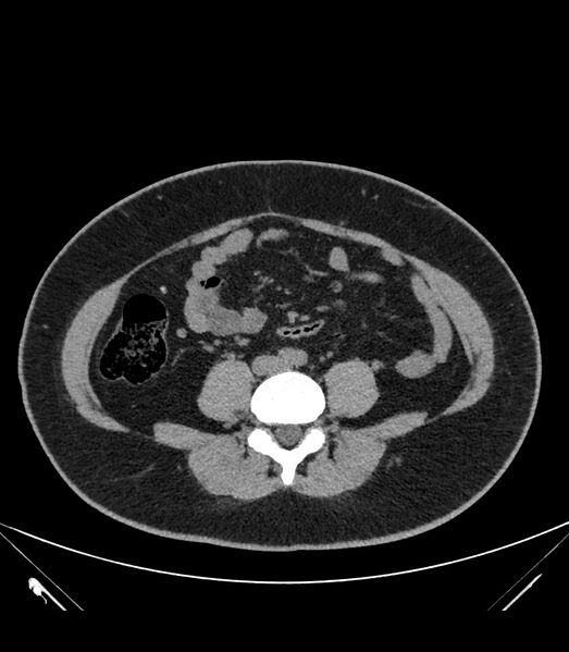 File:Cervical aortic arch with coarctation and aneurysms (Radiopaedia 44035-47552 Axial non-contrast 70).jpg