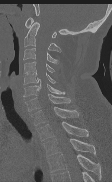 File:Cervical canal stenosis - OPLL and osteophytes (Radiopaedia 47329-51910 Sagittal bone window 38).png
