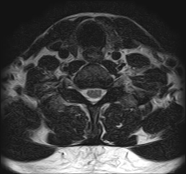 File:Cervical compressive myelopathy (Radiopaedia 71956-82411 Axial T2 15).jpg