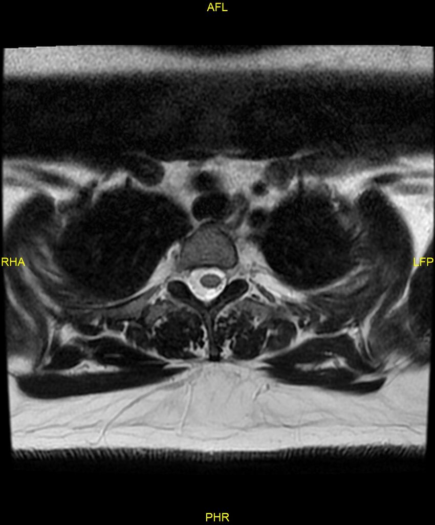 Cervical disc protrusion (Radiopaedia 87147-103415 Axial T2 96).jpg