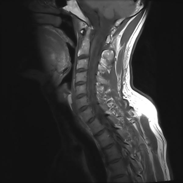 File:Cervical dural CSF leak on MRI and CT treated by blood patch (Radiopaedia 49748-54995 Sagittal T1 3).png