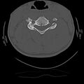 Cervical flexion teardrop fracture with cord hemorrhage (Radiopaedia 32497-33454 Axial bone window 44).jpg