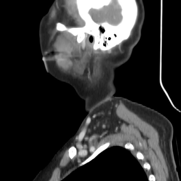 File:Cervical lymphadenopathy- cause unknown (Radiopaedia 22420-22457 D 4).jpg