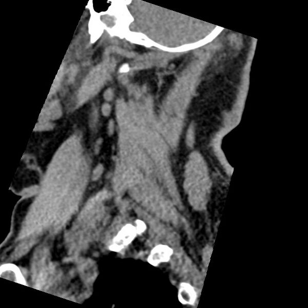 File:Cervical spinal neurofibroma in a patient with NF1 (Radiopaedia 58344-65464 C 47).jpg