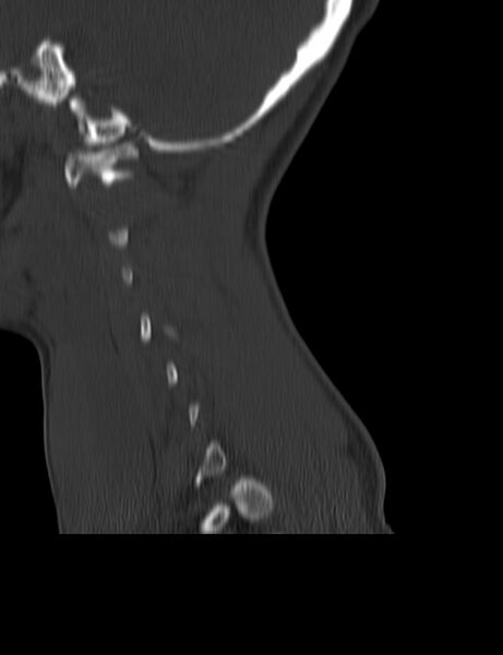 File:Cervical spine posterior ligamentous complex rupture (Radiopaedia 63486-72101 Sagittal bone window 24).jpg