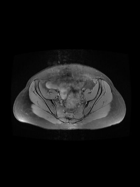 File:Cesarean section scar endometrioma (Radiopaedia 56569-63297 Axial PD fat sat 14).jpg