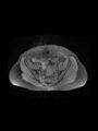 Cesarean section scar endometrioma (Radiopaedia 56569-63297 Axial PD fat sat 14).jpg