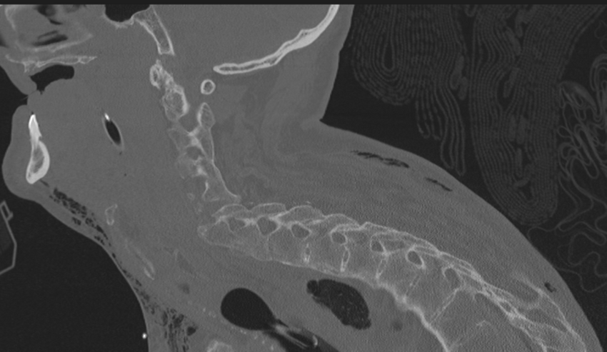 Chalk stick fracture (Radiopaedia 57948-64928 Sagittal bone window 39).png
