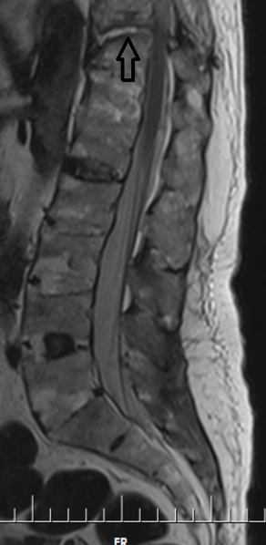 File:Chalk stick fracture - ankylosing spondylitis (Radiopaedia 52572-58485 Sagittal T2 1).png