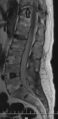Chalk stick fracture - ankylosing spondylitis (Radiopaedia 52572-58485 Sagittal T2 1).png