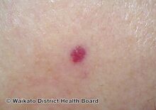Red cherry angioma (direct vision)