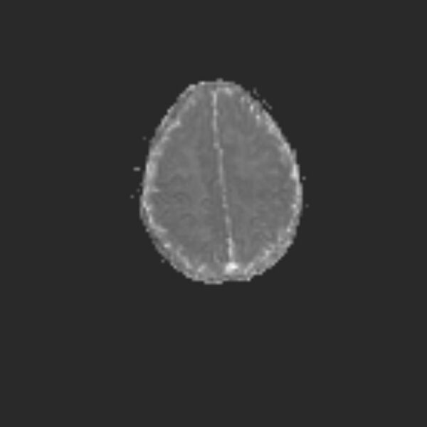 File:Chiari III malformation with occipital encephalocele (Radiopaedia 79446-92559 Axial ADC 18).jpg