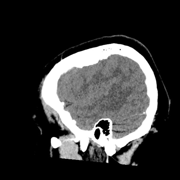 File:Chiasmatic-hypothalamic juvenile pilocytic astrocytoma (Radiopaedia 78533-91237 B 15).jpg