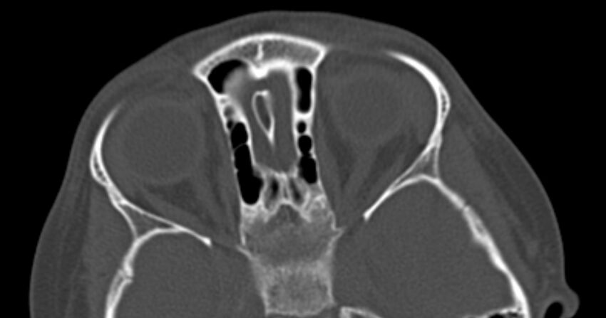 Choanal atresia (Radiopaedia 51295-56972 Axial bone window 51).jpg