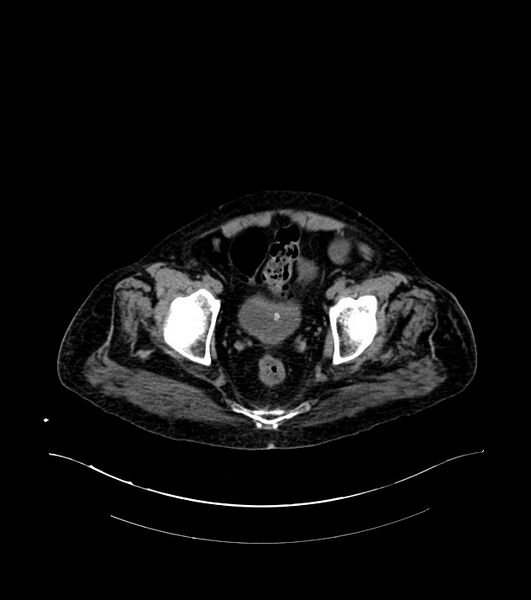 File:Cholangiocarcinoma with cerebral metastases (Radiopaedia 83519-98629 Axial non-contrast 113).jpg