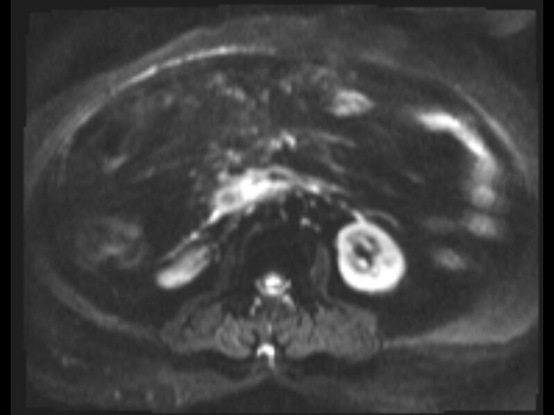 File:Choledocholithiasis causing intrahepatic biliary duct dilation (Radiopaedia 39908-42369 Axial T2 SPAIR 2).jpg