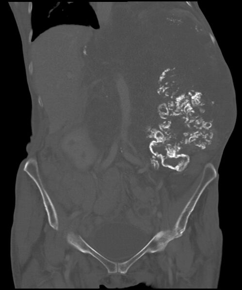 File:Chondrosarcoma of the spine (Radiopaedia 49871-55143 Coronal bone window 21).jpg
