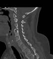 Chordoma (C4 vertebra) (Radiopaedia 47561-52188 Sagittal bone window 34).png
